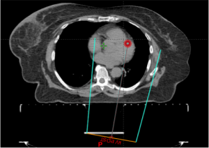 A CT scan of a patient with outlines showing potential radiation treatment areas. 